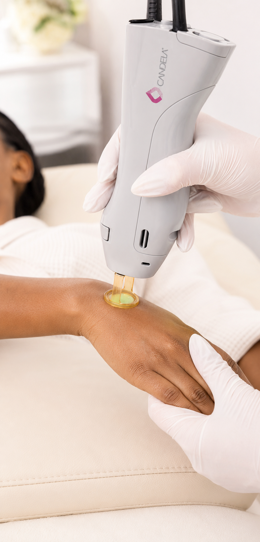 Behandlung des Unterarms mit dem Handstück des Candela GentleMax Pro Plus